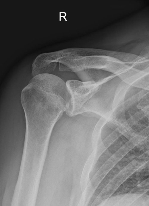 Hintere Schulterluxation Röntgenbild